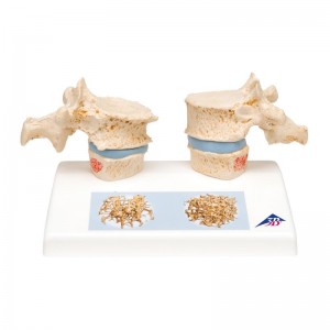 Modello di vertebre con Oteoporosi